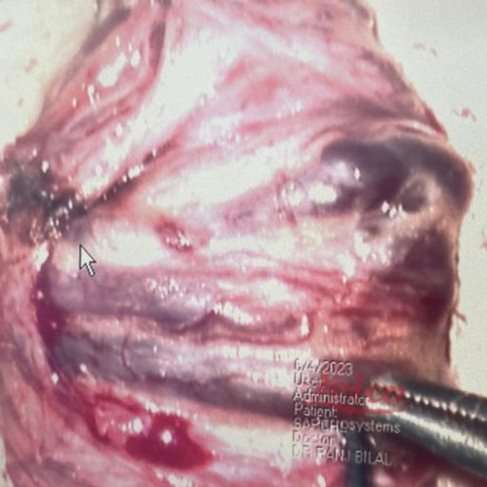 دوالي الخصية الميكروسكوبية